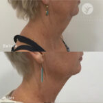 Chin Filler Brisbane Gold Coast Darwin