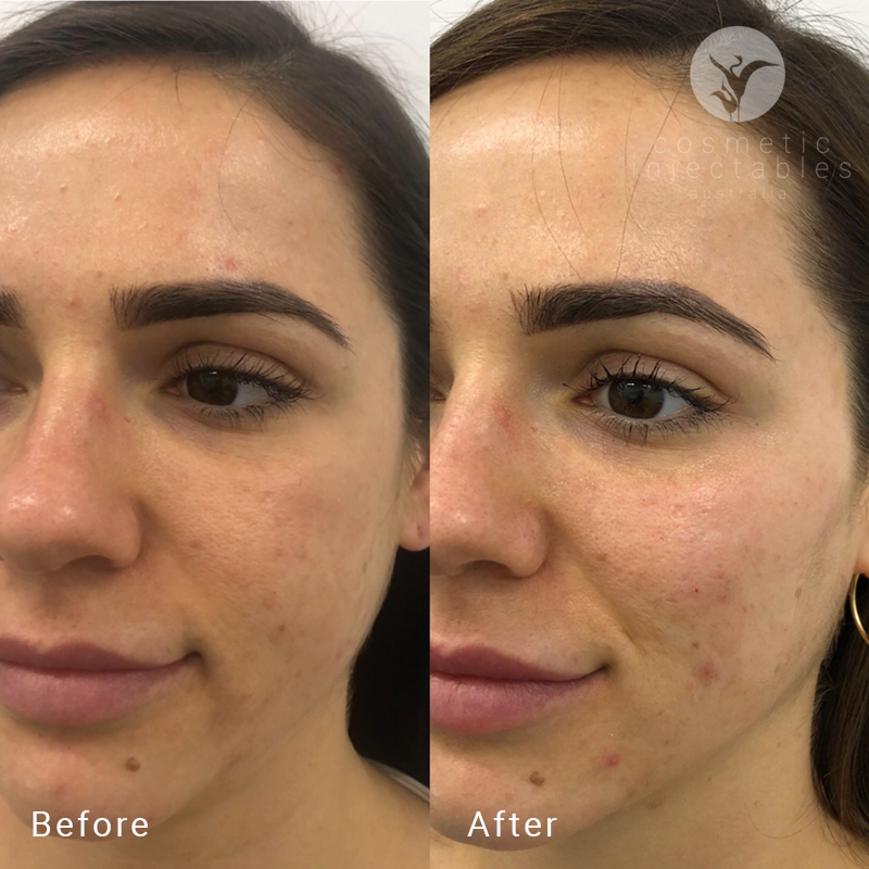 Cheek filler before and after treatment in our Brisbane clinic