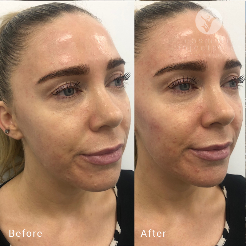Cheek filler before and after results - performed in Brisbane clinic