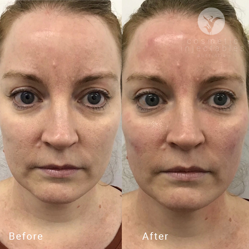 Results from cheek filler treatment performed by Cosmetic Injectables Brisbane