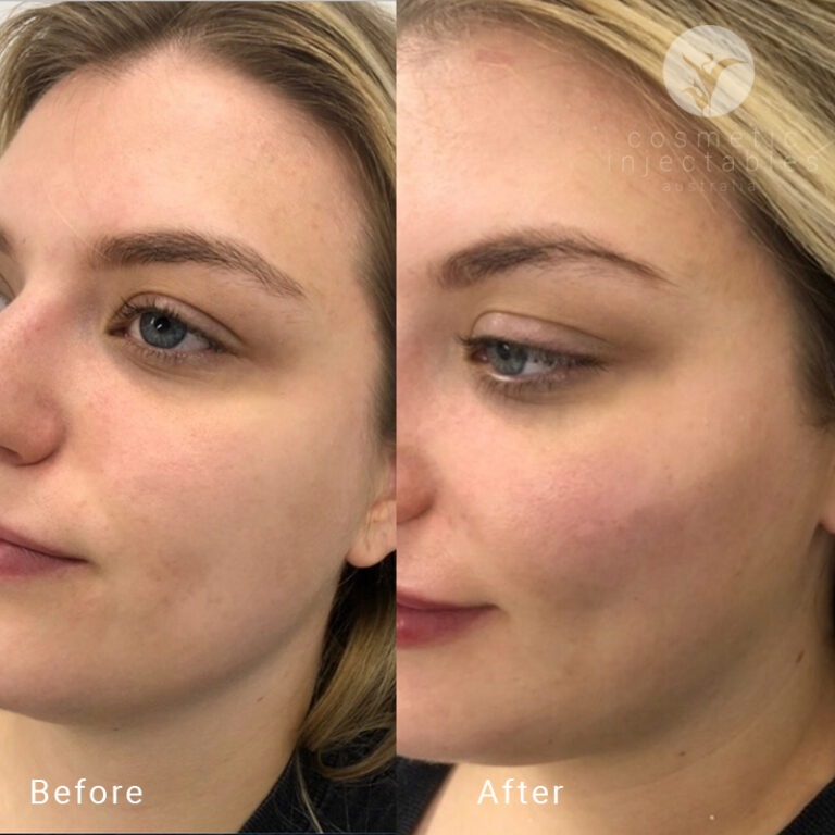Cheek filler results after treatment in our Brisbane clinic