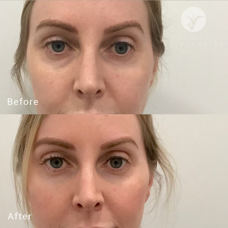 Results from tear trough filler injections performed in our Brisbane clinic