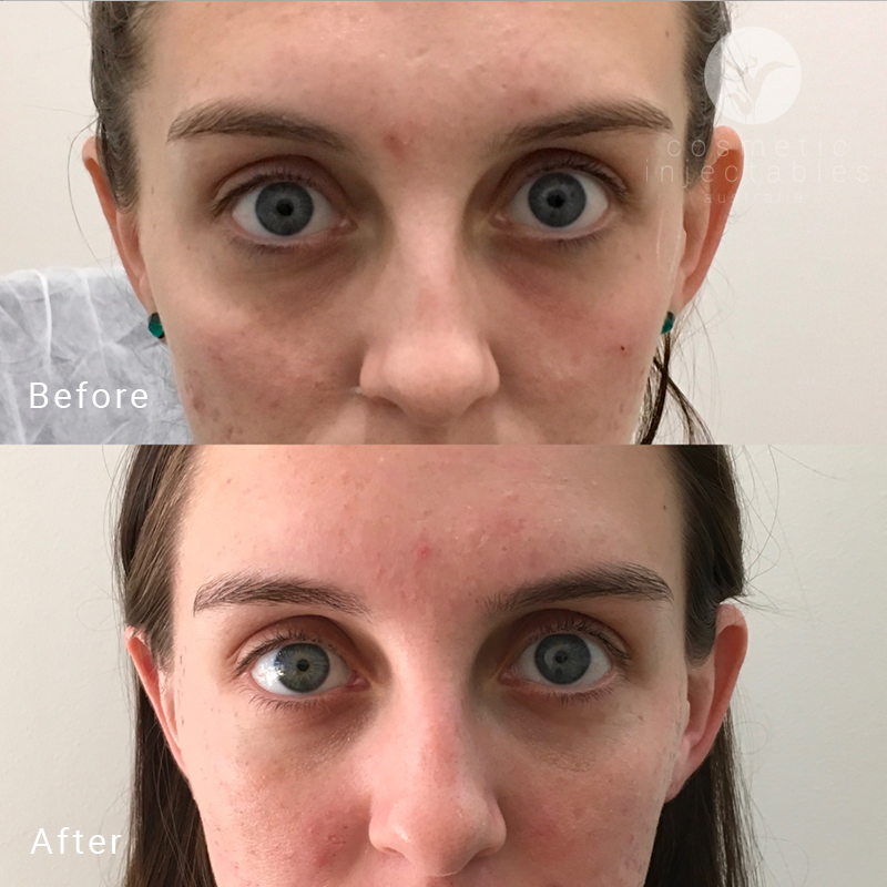Appearance after tear trough filler injections at our Brisbane clinic