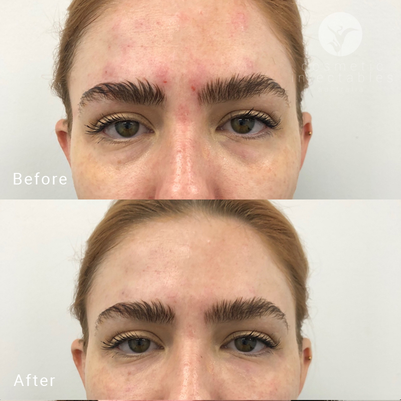 Tear trough filler before and after treatment administered in our Brisbane clinic