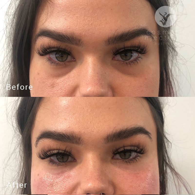 Results from tear trough filler injections
