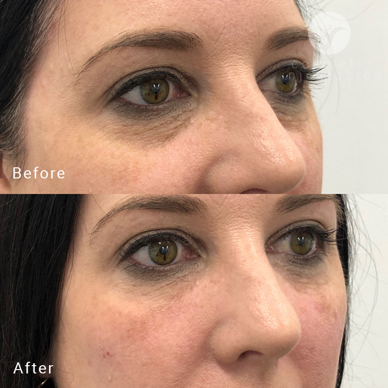 Result of under eye filler injections performed by Cosmetic Injectables Brisbane