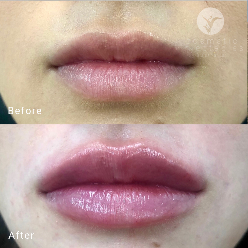 russian lip fillers results