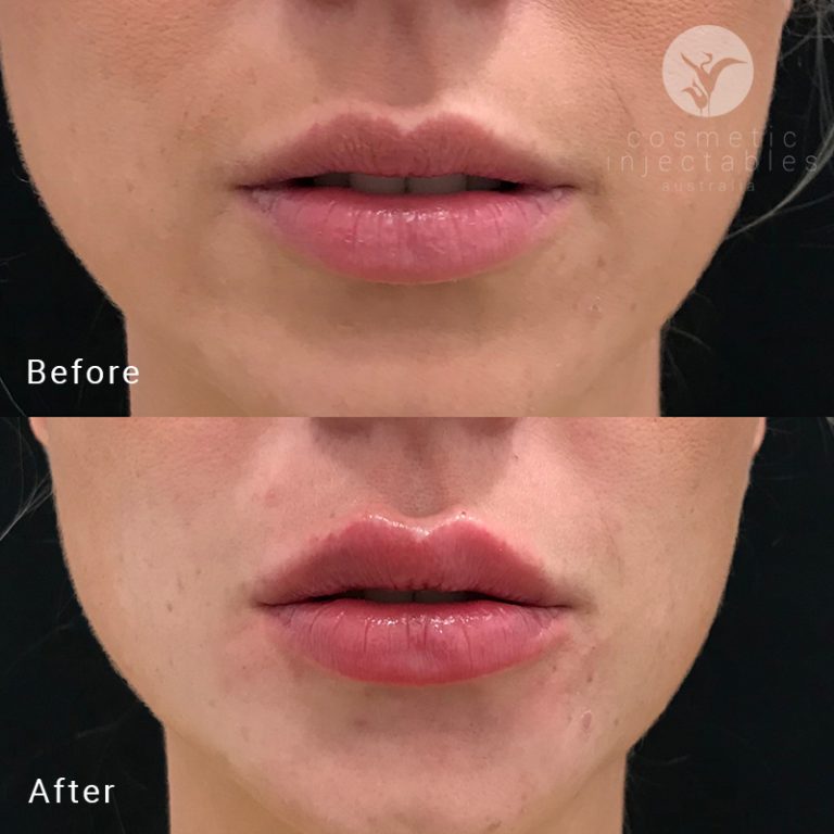 results from lip fillers treatment