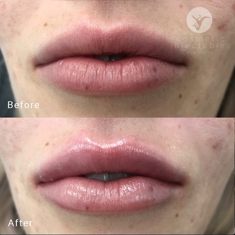 before and after lip fillers at Cosmetic Injectables Australia