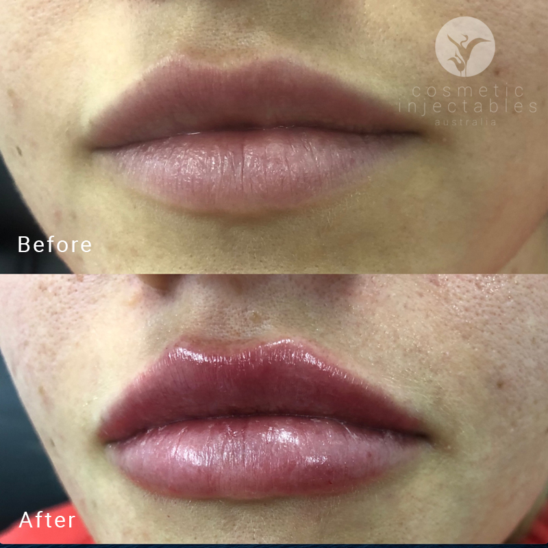 Lip fillers treatment before and after
