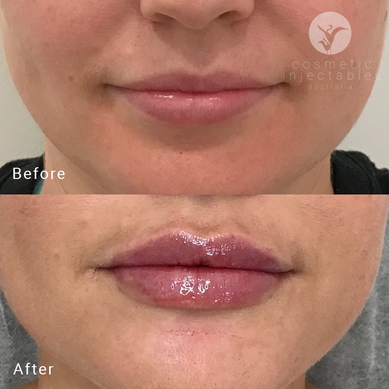 Russian lip filler before and after treatment