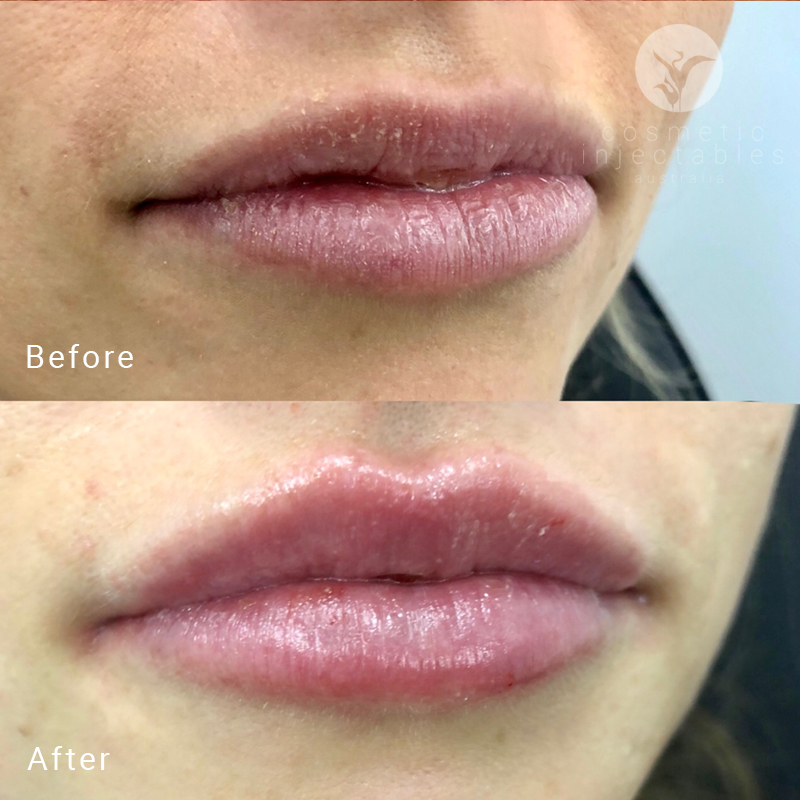Appearance after lip filler treatment