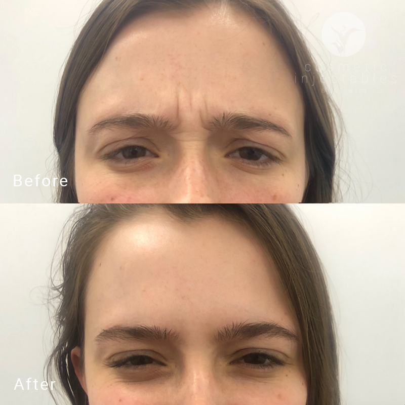 frown lines Anti Wrinkle treatment results for one of our Brisbane clients