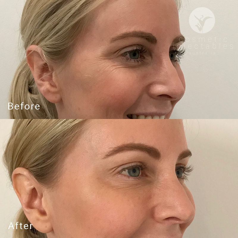 Crows feet Anti Wrinkle Injections results in our Brisbane clinic