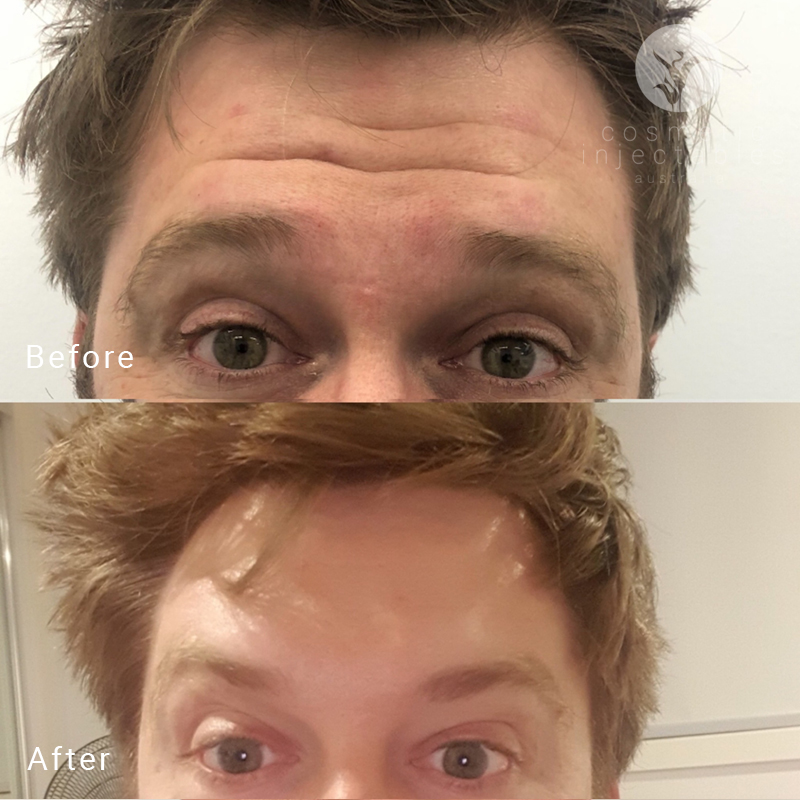 Forehead Anti Wrinkle Treatment before and after