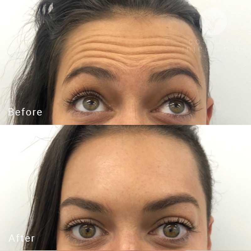 Anti Wrinkle injections results performed in our Brisbane clinic