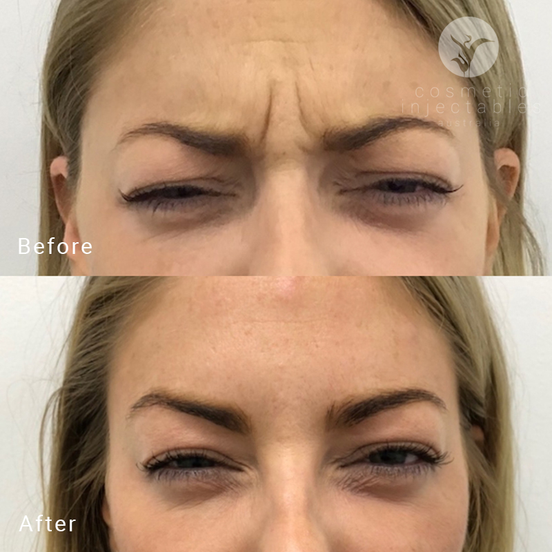 Anti Wrinkle Injection results after treatment in our Brisbane clinic