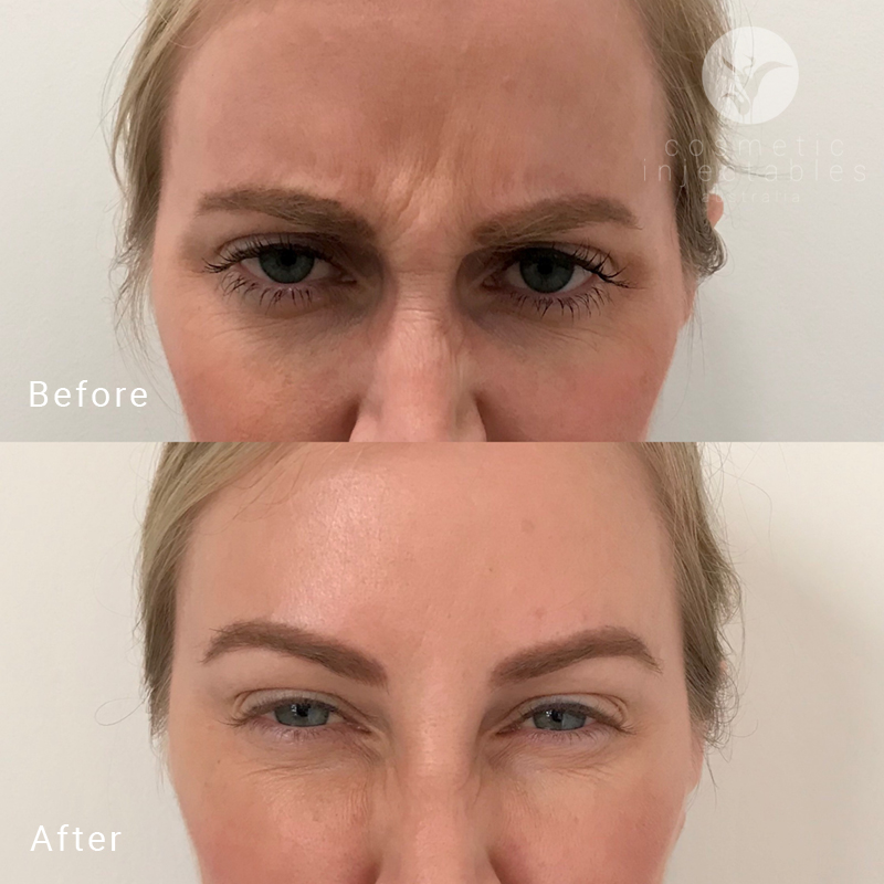 Wrinkle reduction after injectables treatment in our Brisbane clinic