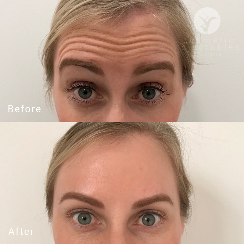 Results from Anti Wrinkle Injection treatment performed in our Brisbane clinic