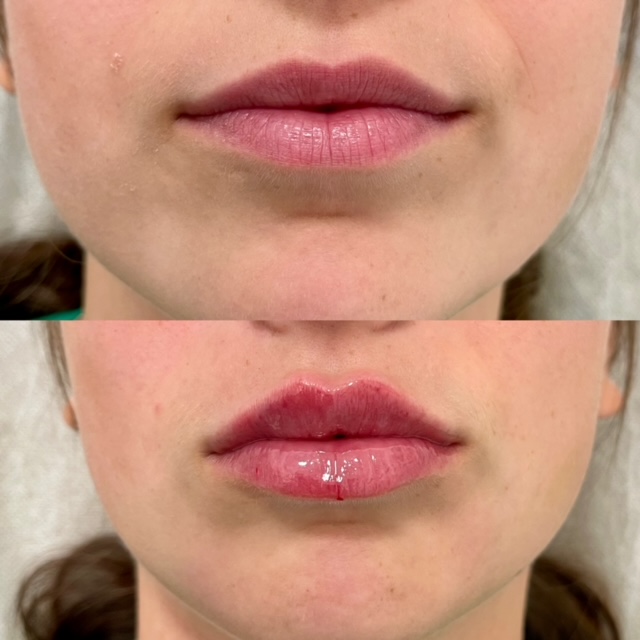 lip filler results from treatment