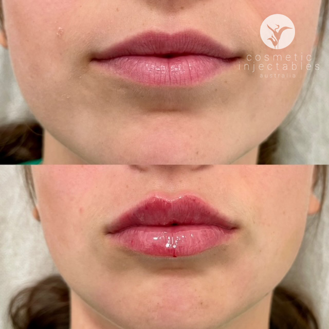 before and after lip filler performed in our injectables clinic