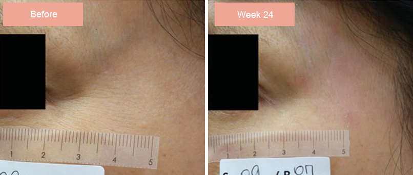 Before and After results from Rejuran